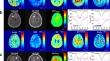 Multi-pool chemical exchange saturation transfer MRI in glioma grading, molecular subtyping and evaluating tumor proliferation.