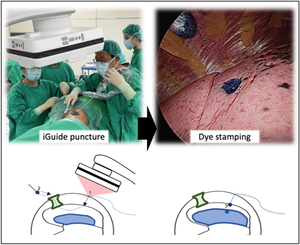 Nontraumatic intraoperative pulmonary nodule localization with laser guide stamping in a hybrid operating room.