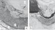 Effect of Quenching and Aging on the Microstructure and Mechanical Properties of Welded Joints Obtained by Laser Welding of Titanium and Aluminum Alloys