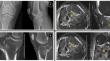 Tibial plateau fractures are associated with ligamentous and meniscal injuries. Preoperative evaluation of magnetic resonance imaging influences surgical treatment.