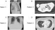 18q Deletion Syndrome Presenting with Late-Onset Combined Immunodeficiency.