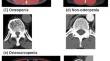 Osteosarcopenia: the coexistence of sarcopenia and osteopenia is predictive of prognosis and postoperative complications after curative resection for colorectal cancer.