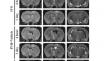 Complement Inhibition Reduces Early Erythrolysis, Attenuates Brain Injury, Hydrocephalus, and Iron Accumulation after Intraventricular Hemorrhage in Aged Rats.