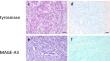 Expression of the tumor antigens NY-ESO-1, tyrosinase, MAGE-A3, and TPTE in pediatric and adult melanoma: a retrospective case control study.