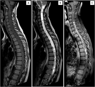 Holocord pilocytic astrocytoma in a young woman with intracranial extension: case report and review of the MRI characteristics.