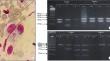 Clinical polymorphism of zoonotic cutaneous leishmaniasis: combination of the clinical and the parasitological diagnosis.