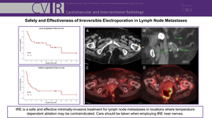 Safety and Effectiveness of Irreversible Electroporation in Lymph Node Metastases.