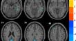 Altered Intrinsic Brain Activity in Ischemic Stroke Patients Assessed Using the Percent Amplitude of a Fluctuation Method.