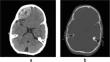 Post-craniotomy leptomeningeal cyst: a new presentation of an old problem.