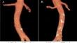 Abdominal aortic calcification volume as a preoperative prognostic predictor for pancreatic cancer.