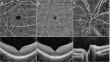 Retinal vessel density and choroidal flow changes in oligoarticular juvenile idiopathic arthritis with and without uveitis.