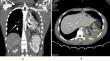 Esophageal Injury Masquerading as Diaphragmatic Injury