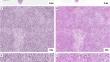 AI-based computational H&E staining in lymphomas.