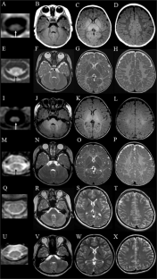 A novel heterozygous TMEM63A variant in a familial case with early onset nystagmus, severe hypomyelination, and a favorable adult prognosis.