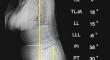 Morphological features of lower lumbar degenerative kyphosis.