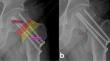 Investigation of Novel Radiological Parameters to Predict Treatment Failure and Ideal Surgical Interventions in Young Femoral Neck Fractures Treated with Triple Cannulated Screw: A Retrospective Analysis