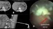 Percutaneous Cryoneurolysis of Splanchnic Nerves Under Combined Computed Tomography and Endoscopy Guidance: Pushing the Boundaries of Hybrid Imaging.