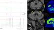 Ocular Flutter Evoked by Vestibular Stimulation in Multiple System Atrophy with Predominant Cerebellar Ataxia.