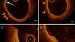 Optical Coherence Tomography in the Assessment and Management of Cardiac Allograft Vasculopathy.