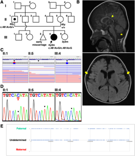 A novel homozygous variant of the PIGK gene caused by paternal disomy in a patient with neurodevelopmental disorder, cerebellar atrophy, and seizures.