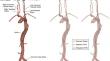 Autonomous navigation of catheters and guidewires in mechanical thrombectomy using inverse reinforcement learning.