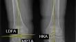 Comparison of the efficacy and safety of MAKO robot-assisted total knee arthroplasty versus conventional manual total knee arthroplasty in uncomplicated unilateral total knee arthroplasty a single-centre retrospective analysis.