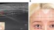 Sonoanatomy of injecting botulinum neurotoxin into the facial muscles.