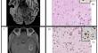 Characteristics of H3K27M-mutant diffuse gliomas with a non-midline location.