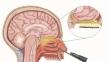 Effect of endoscopic endonasal skull base approaches on olfactory function and facial development in children.