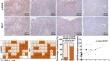 Antitumor activity of afatinib in EGFR T790M-negative human oral cancer therapeutically targets mTOR/Mcl-1 signaling axis.