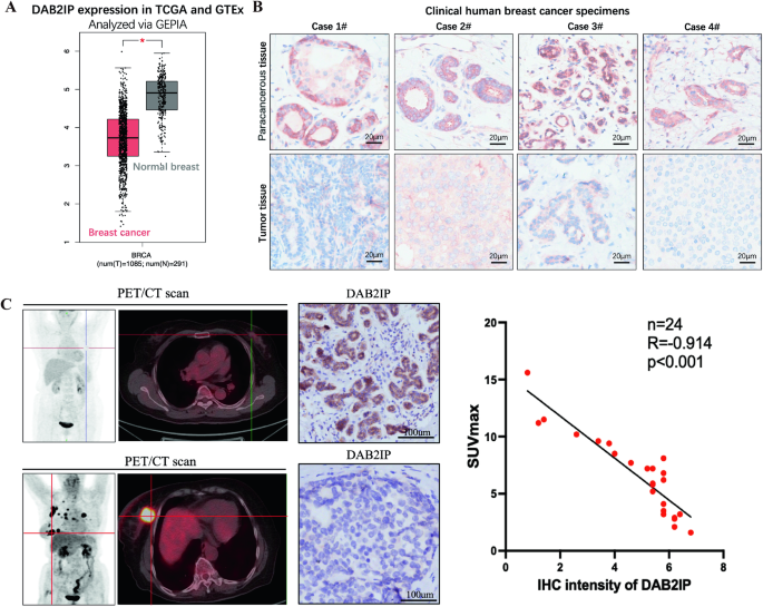 DAB2IP inhibits glucose uptake by modulating HIF-1α ubiquitination under hypoxia in breast cancer.