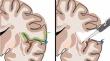 Frontal trans opercular approaches to the insula: building the mental picture from procedure-guided anatomical dissection.