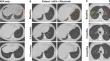 Lymphocyte-Directed Immunomodulation Remits Thymoma-Associated Autoimmune Pneumonitis.