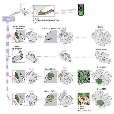 Early rhombic lip Protogenin<sup>+ve</sup> stem cells in a human-specific neurovascular niche initiate and maintain group 3 medulloblastoma.