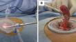 Factors prolonging the operative time for transumbilical laparoscopic-assisted appendectomy in pediatric patients: a retrospective single-center study.