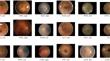 Diabetic Retinopathy Fundus Image Classification Using Ensemble Methods