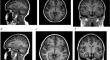 Evaluation of 3D T1-weighted spoiled gradient echo MR image quality using artificial intelligence image reconstruction techniques in the pediatric brain.