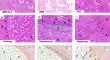 Histopathological growth pattern and vessel co-option in intrahepatic cholangiocarcinoma.