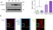 S100A11 is involved in the progression of colorectal cancer through the desmosome-catenin-TCF signaling pathway.