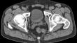 Solitary fibrous tumor within the mesorectum: literature review based on a case report of resection by transanal minimally invasive surgery (TAMIS).