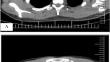 Infectious mononucleosis complicated by transitory Epstein-Barr virus infection of T and natural killer cells.