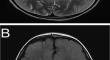 Cerebral White Matter Alterations Associated With Oligodendrocyte Vulnerability in Organic Acidurias: Insights in Glutaric Aciduria Type I.