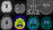 Complete resolution of restless legs syndrome following ischemic stroke of the right middle cerebral artery