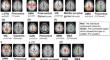 Correlation of altered intrinsic functional connectivity with impaired self-regulation in children and adolescents with ADHD.