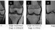 Forensic age estimation by MRI of the knee - comparison of two classifications for ossification stages in a German population.