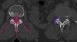 Are the facet joint parameters risk factors for cage subsidence after TLIF in patients with lumbar degenerative spondylolisthesis?