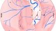 Trans-temporal trans-choroidal resection of thalamic and thalamopeduncular tumors: how I do it.