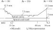 Effect of the Pulsating Flow of Cerebrospinal Fluid on Spinal Pathologies