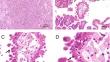 Analyzing the correlation between low proportion of hobnail features in papillary thyroid carcinoma and clinical aggressiveness risk.