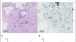 Immunohistochemical analysis of tumor budding in stage II colon cancer: exploring zero budding as a prognostic marker.